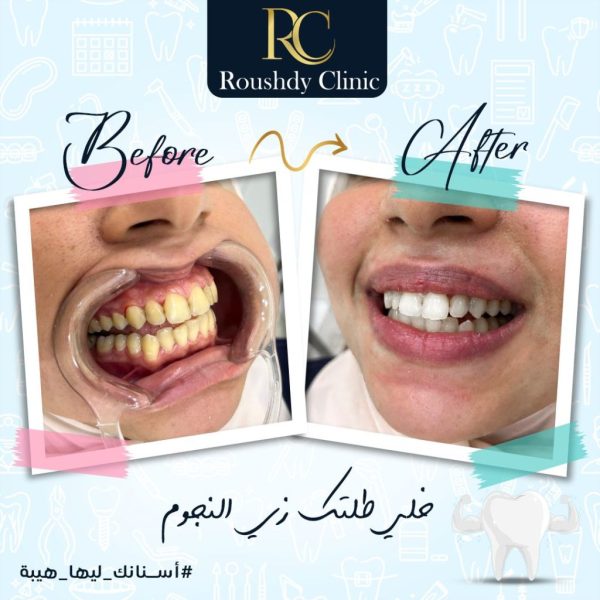 roushdy clinics - dental-cases-003