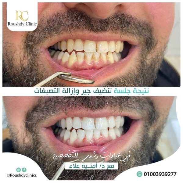 roushdy clinics - dental-cases-011